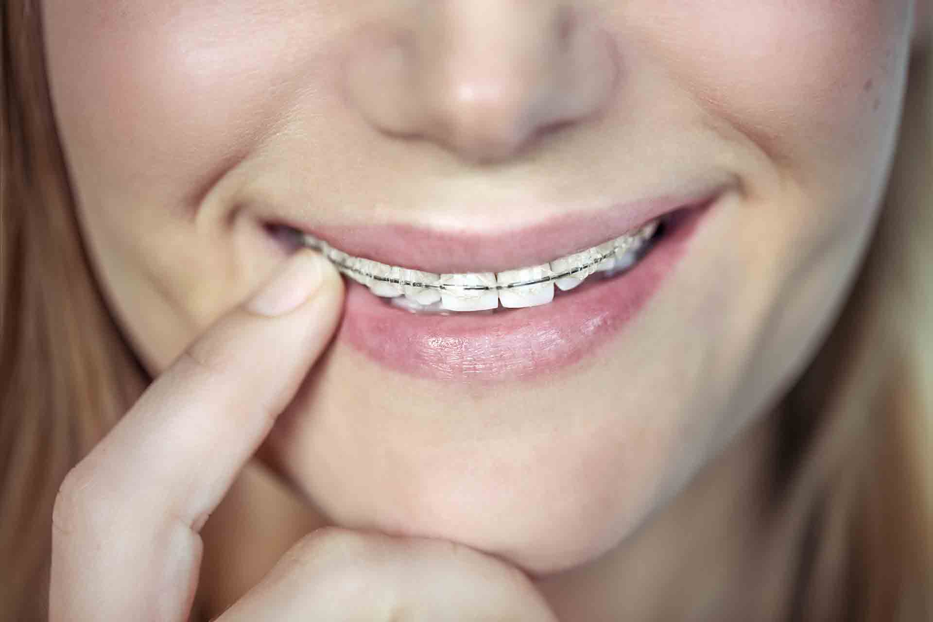 I denti possono “tornare storti”?